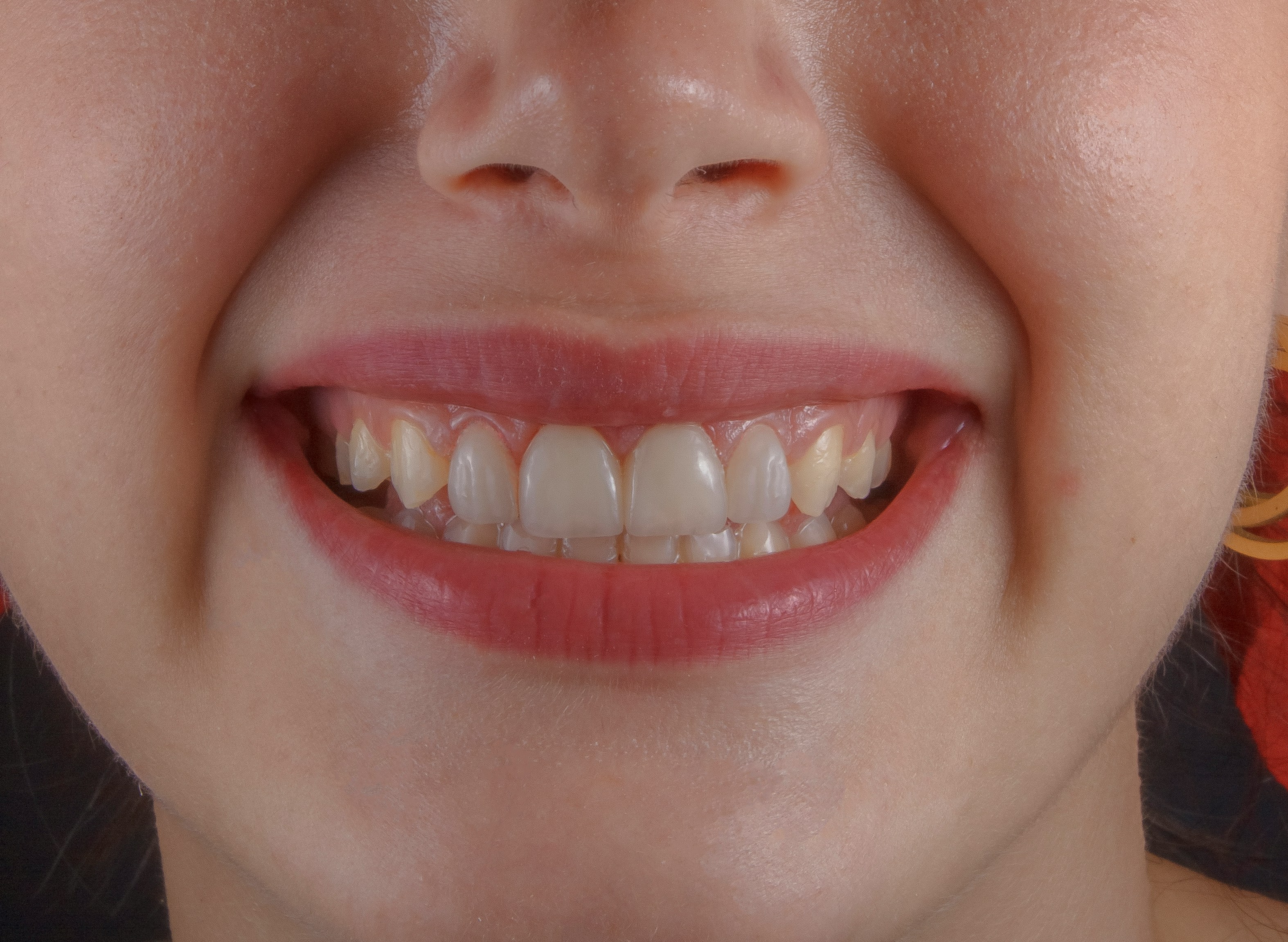 Bright smile consultation result at Castle Way Dental