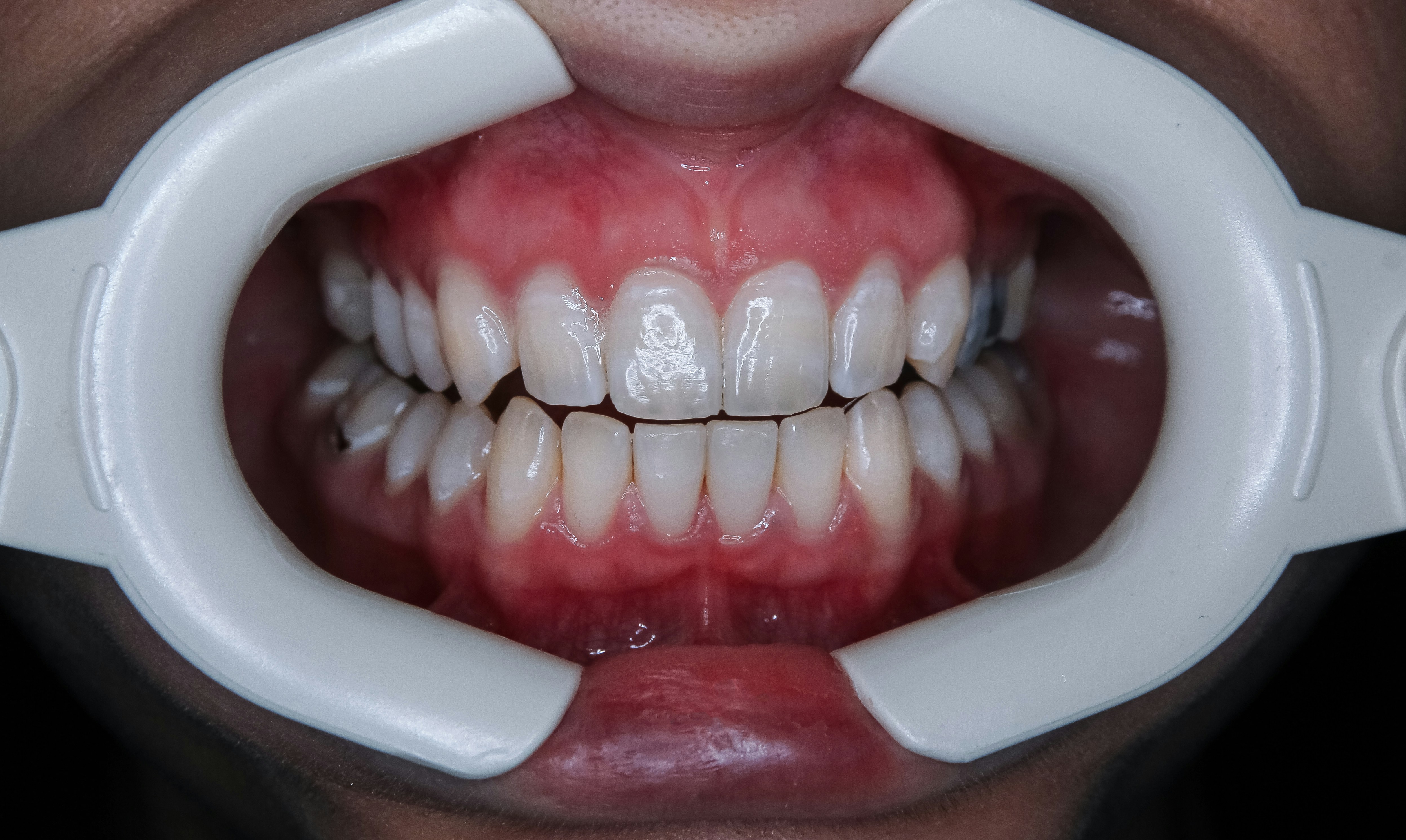 Close-up smile after teeth whitening